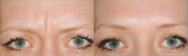 Dysport® treatment Before and After Images