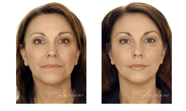 Restylane® treatments Before & After Photos