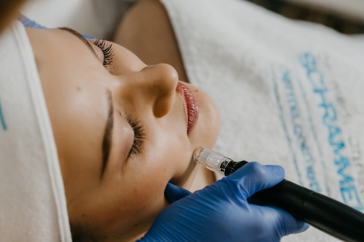 pico-laser-treatment-in-los-angeles