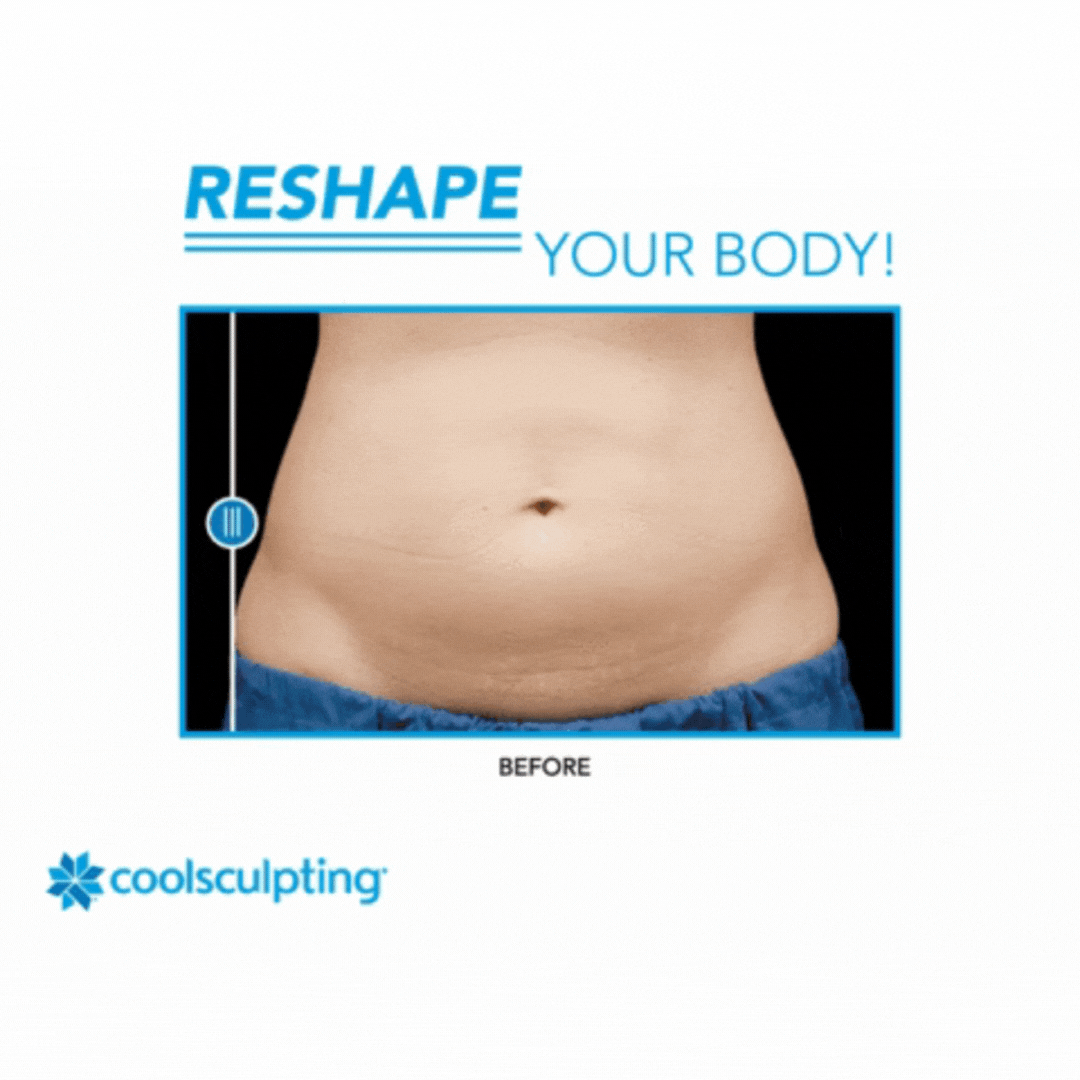 Coolsculpting Before and After Abdomen Image