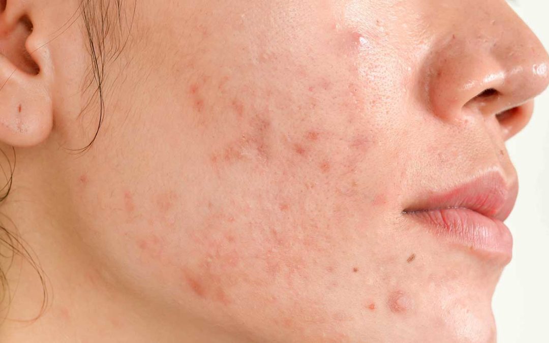 5 Reasons Why You Need Acne Scar Treatment in Los Angeles, CA