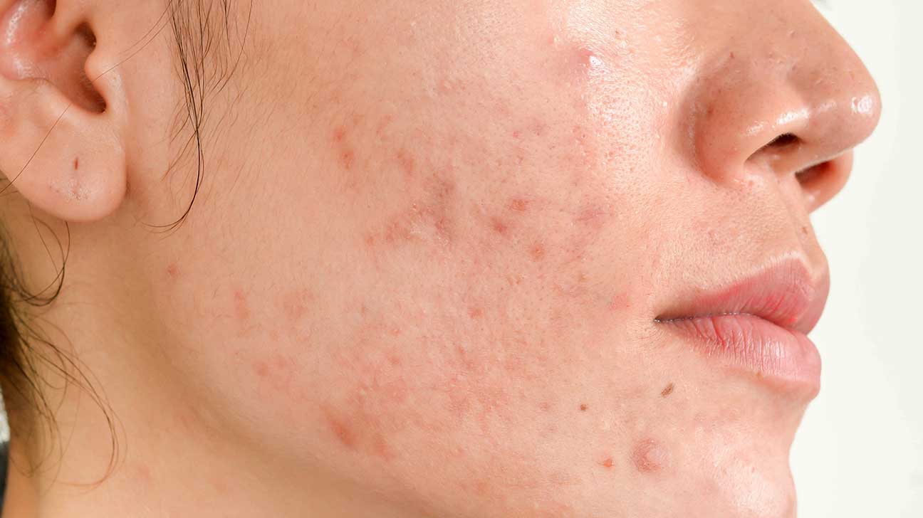 acne-scar-treatment-los-angeles