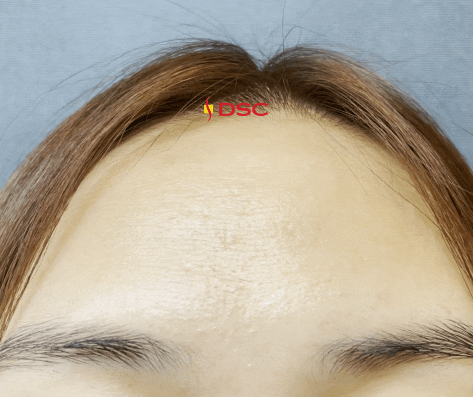 DSC Gif of person frowning glabellar to show eleven's wrinkles and lifting eyebrows to show forehead wrinkles