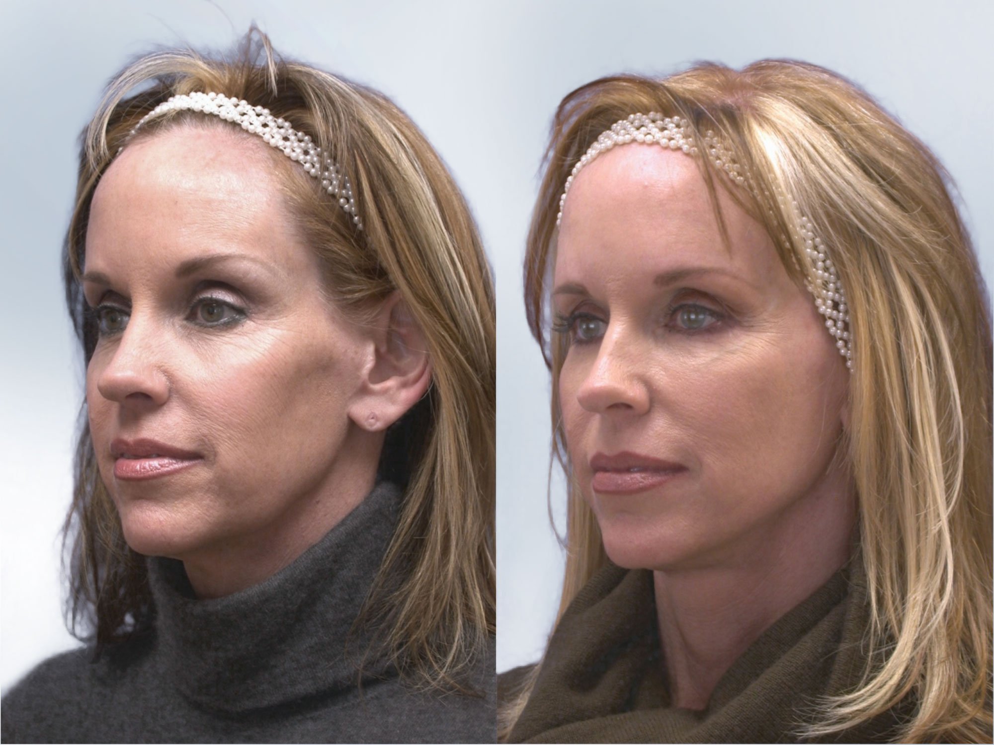 Before and After Sculptra treatment images of a woman's face at a 45 degree angle facing left showing marked improvement in cheek hollowness and facial volume after treatment