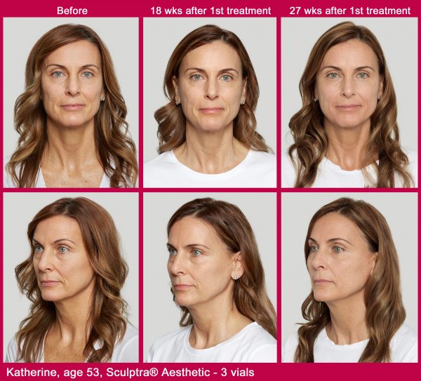 Before and after images of a woman's face of treatment with Sculptra - before, 15 weeks after 1st treatment, and 27 weeks after treatment