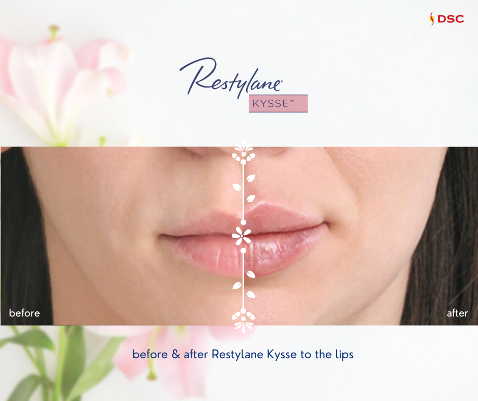 Restylane Kysse filler injection to the lips before and after