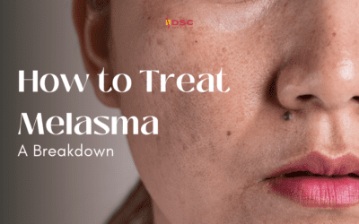 How to Treat Melasma