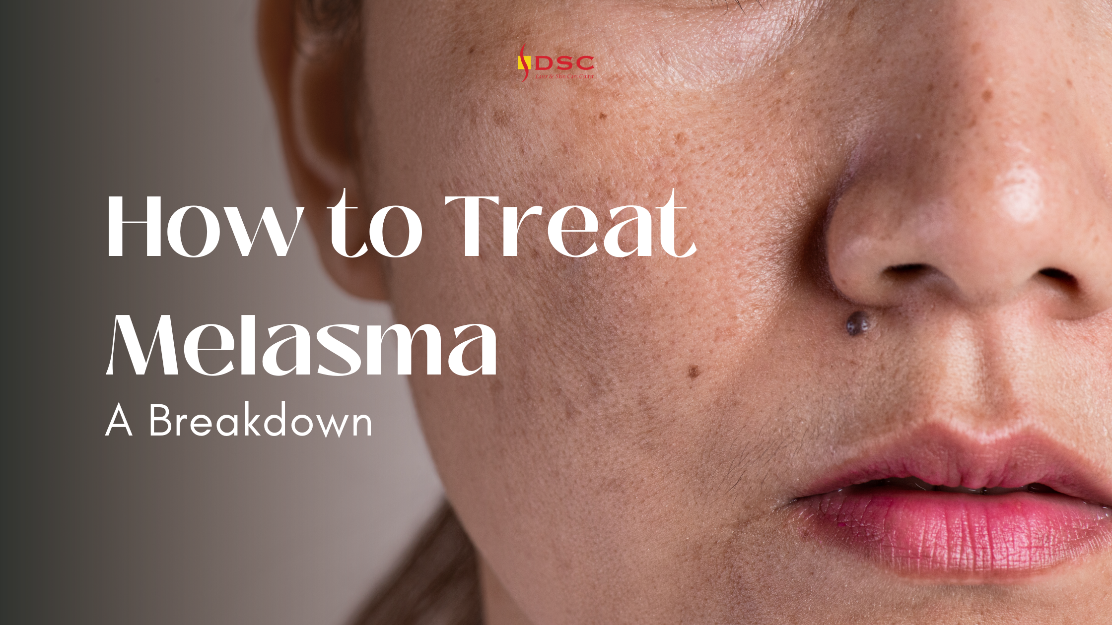 DSC How to Treat Melasma Blog Banner "How to Treat Melasma" text above "A Breakdown" text to the left with DSC logo at top center overlaying a face with pigmentation spots