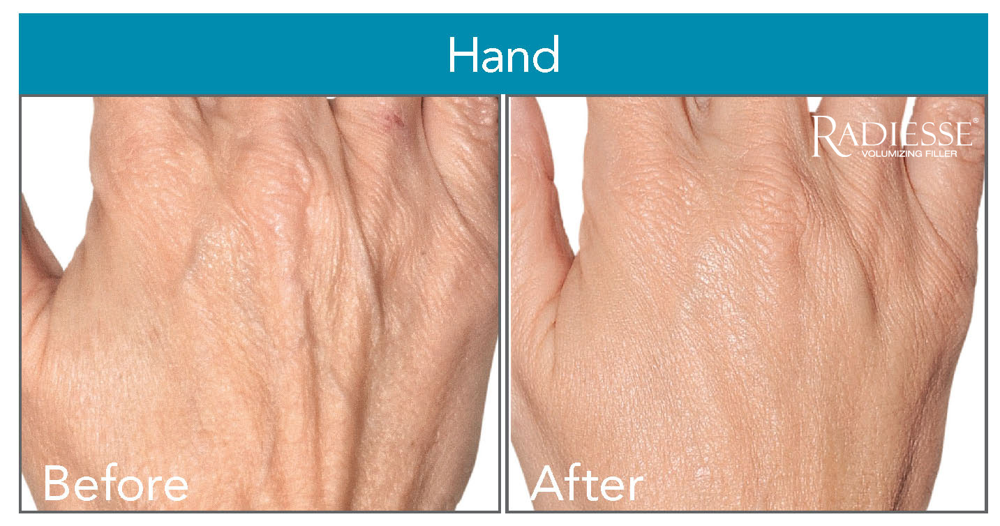 Before and after images of Radiesse injected to the backs of the hands to alleviate signs of aging-related volume loss