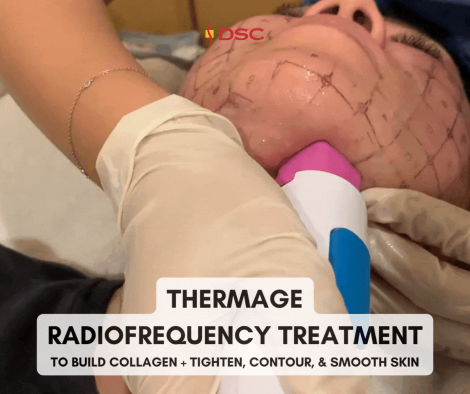 DSC Thermage Treatment Blog Gif featuring face being treated with Thermage FLX treatment on submentum area