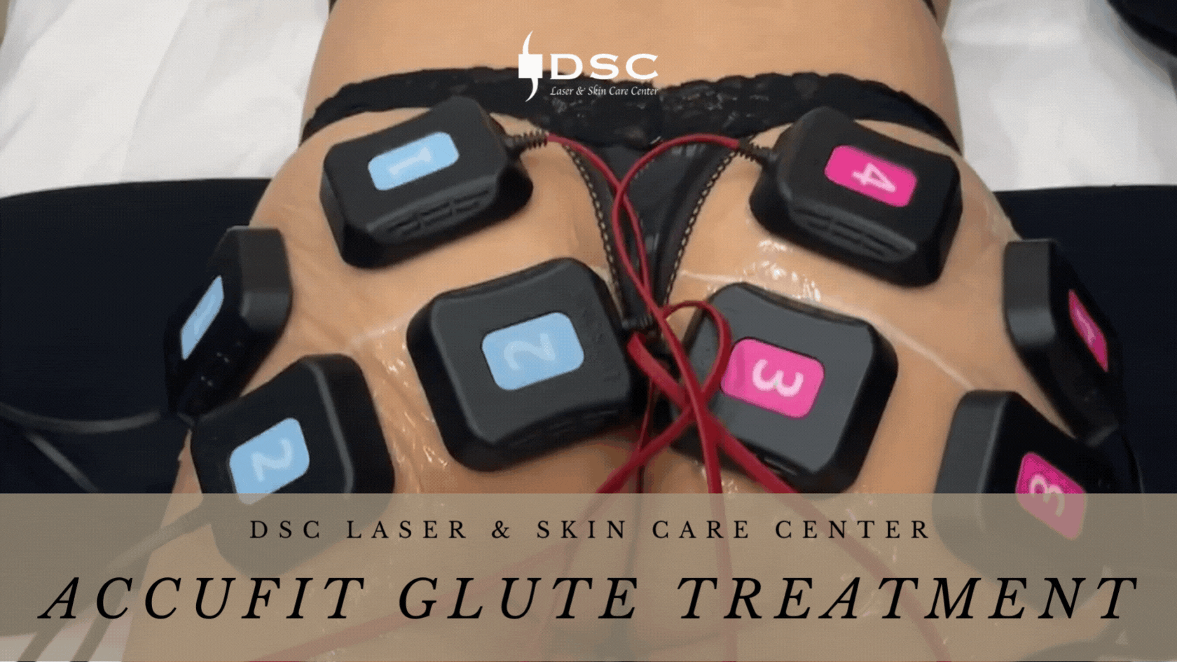 DSC Accufit treatment to glutes gif with Accufit contacts attached to glutes showing glute muscle contraction