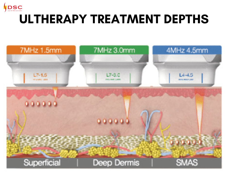 DSC Ultherapy Treatment Depths Blog Graphic depicting 1.5mm transducer targeting superficial skin, 3.0mm transducer targeting dermis, and the 4.5mm transducer targeting the SMAS