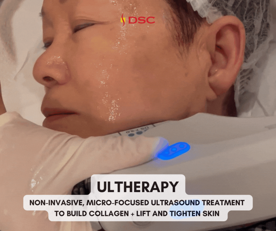 DSC Ultherapy treatment gif depicting Ultherapy handpiece being placed on person's face and ultrasound energy being delivered to cheek area with text overlay "Ultherapy non-invasive, micro-focused ultrasound treatment to build collagen + lift and tighten skin" in center bottom