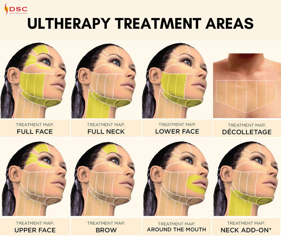 DSC Ultherapy Treatment Areas Blog Graphic featuring image of faces with highlighted treatable areas with Ultherapy on the face and neck - lower face, neck, chest, temples, forehead, & lip area