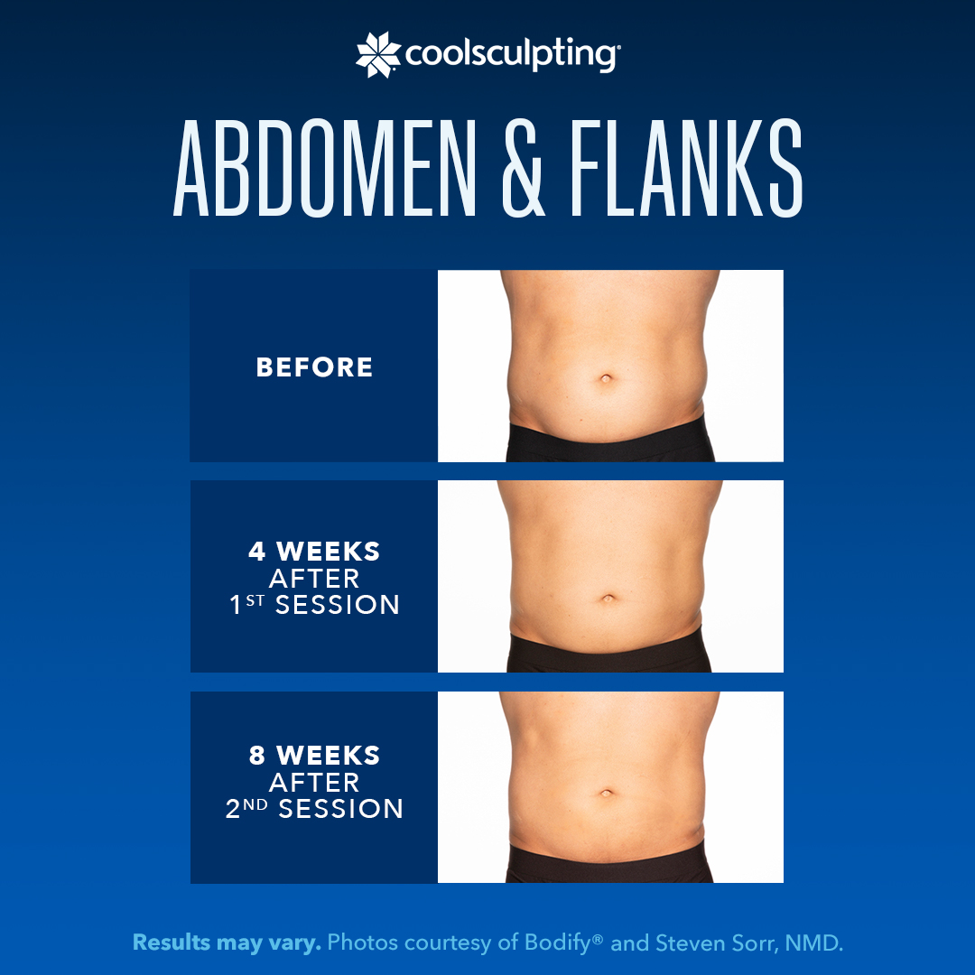 Coolsculpting Before During and After Abdomen and Flanks on Male Body showing before photo at the top, 4 weeks after 1st session in the middle, and 8 weeks after 2nd session photo at the bottom with all abdomens straight on