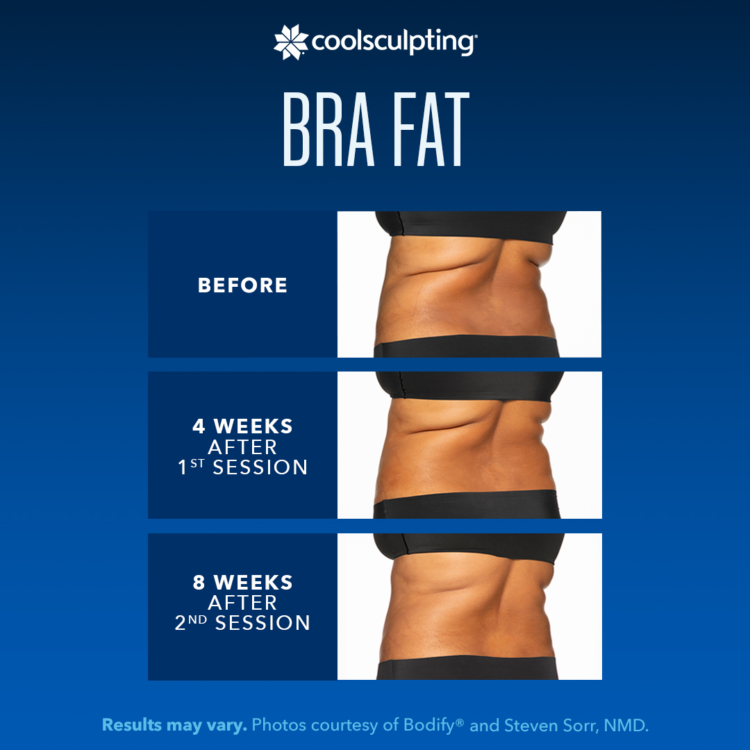 Coolsculpting Before During and After Bra Fat Images depicting before photo at tip, 4 weeks after 1st session photo in the middle, and 8 weeks after 2nd session at the bottom of female back at 45 degree angle