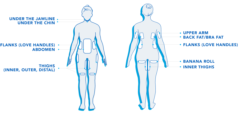 Female silhouette with possible Coolsculpting treatment areas delineated - chin, anterior abdomen, flanks, knees, banana roll (under the glutes), arms, back/bra bulge, and thighs