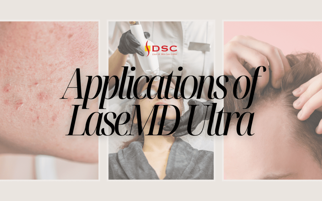 DSC blog banner with text "Applications of LaseMD Ultra" over images of cheek with acne blemishes, LaseMD Ultra laser handpiece treating a face, and fingers in hair