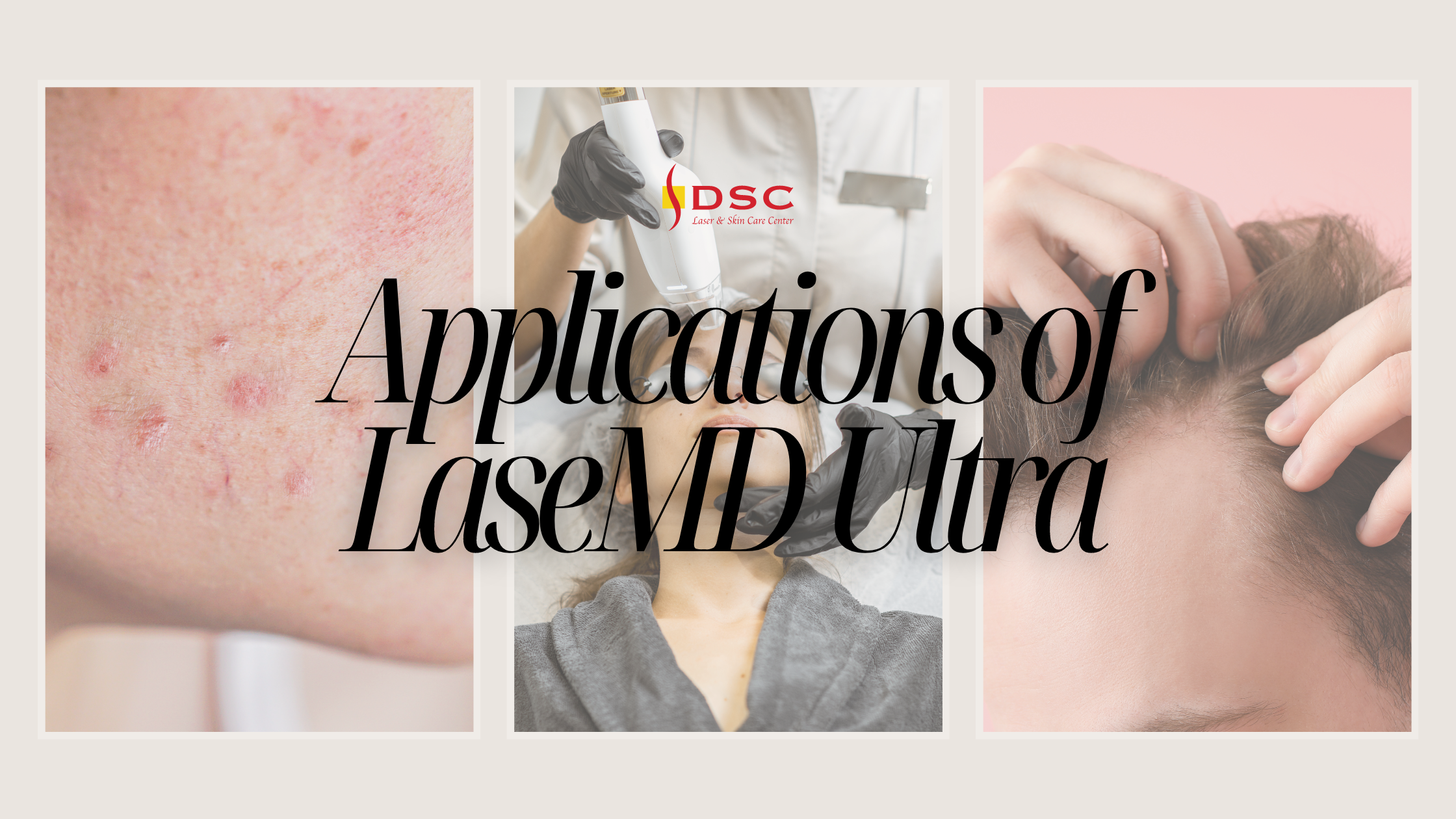 DSC blog banner with text "Applications of LaseMD Ultra" over images of cheek with acne blemishes, LaseMD Ultra laser handpiece treating a face, and fingers in hair