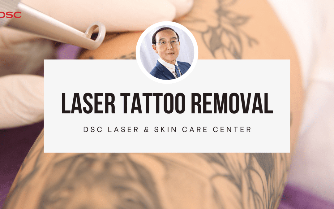 All About Laser Tattoo Removal