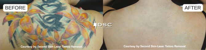 DSC Before and After Discovery Pico Laser Tattoo Removal Treatment Blog Graphic showing colorful back tattoo on left before laser tattoo removal treatment with Discovery Pico laser and back with no tattoo after laser tattoo removal treatment on the right with DSC logo in the middle and the text before and after on left and right top respectively 