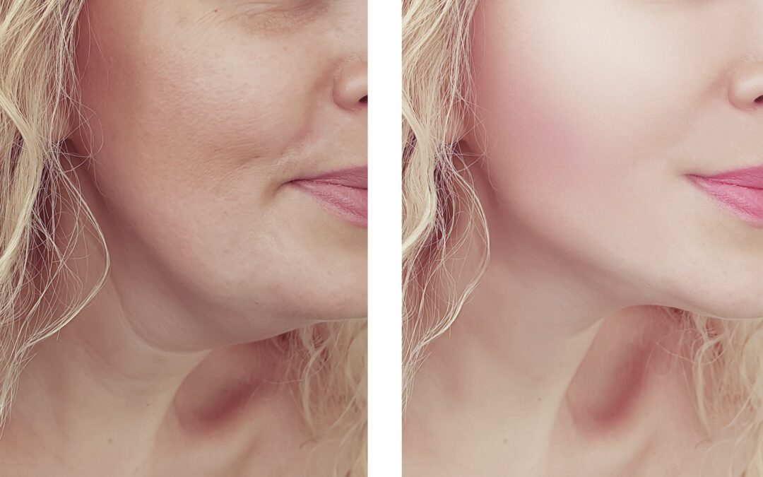 Effective Solutions to Say Goodbye to Double Chin: 10 Strategies That Work