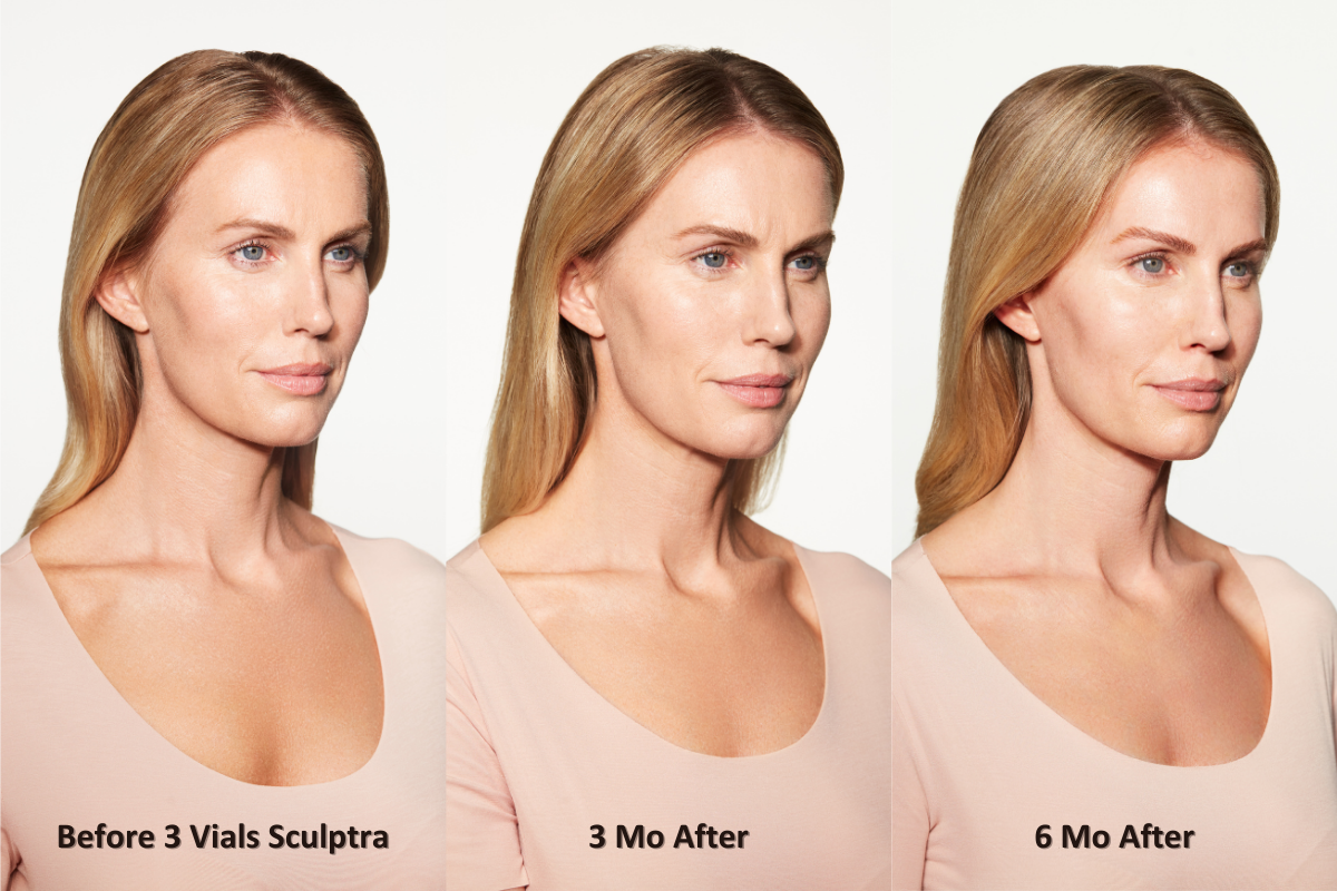 Sculptra before and after Chloe side view Sculptra before and after Chloe side view from left to right: before 3 vials of Sculptra, 3 months after treatment, 6 months after treatment