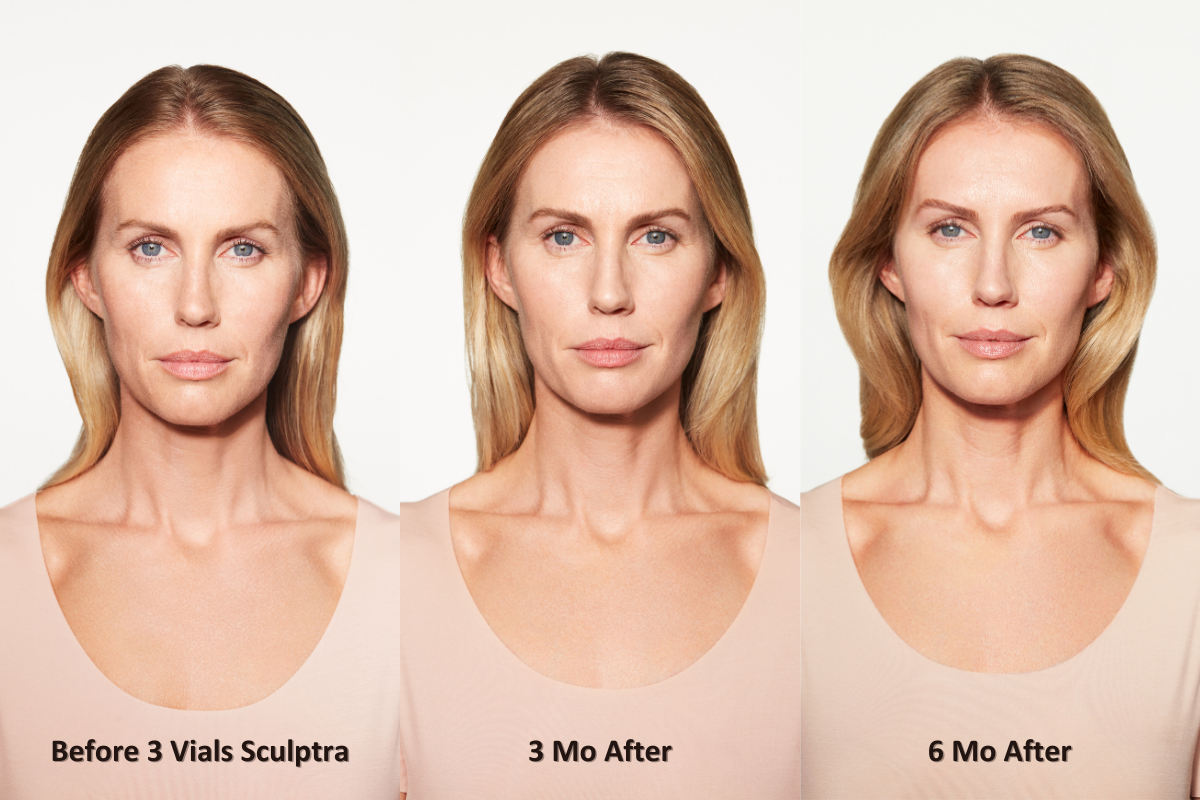 scupltra before and after chloe front facing scupltra before and after chloe front facing from left to right: before 3 vials of Sculptra, 3 months after, and 6 months after