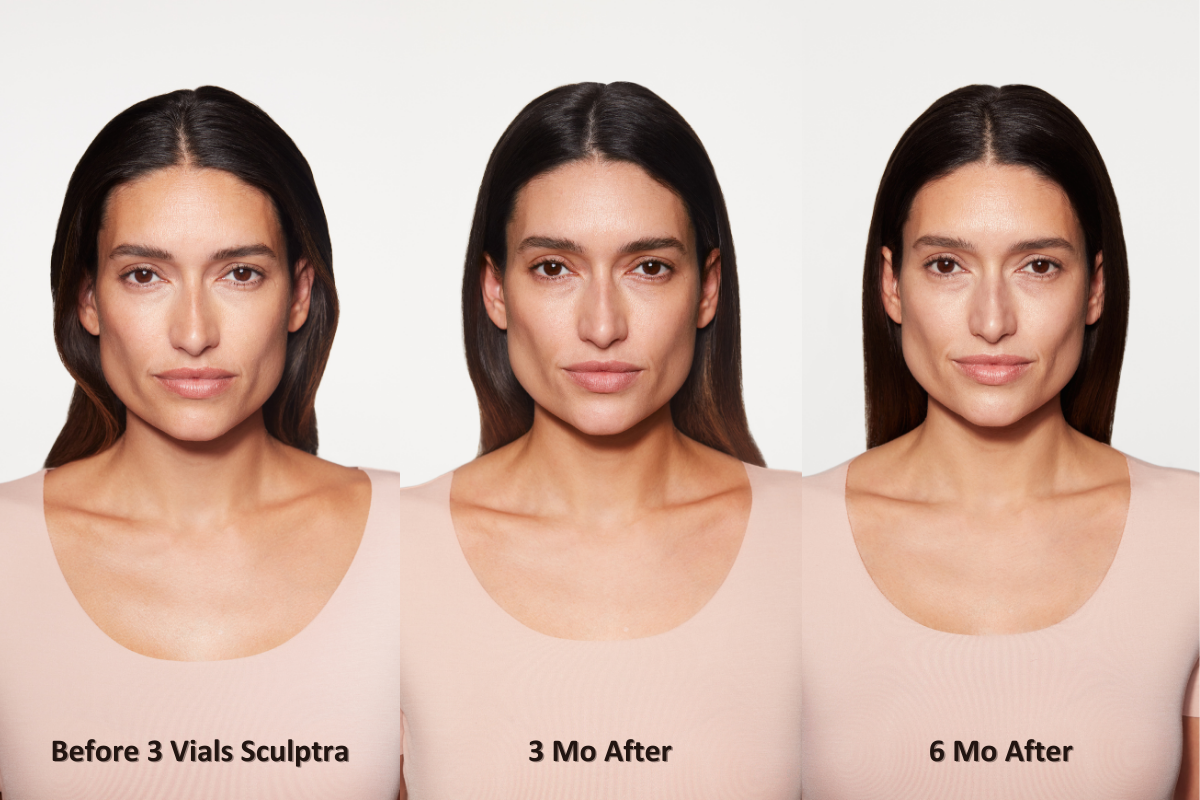 Sculptra before and after front facing gabriella Sculptra before and after front facing from left to right: before 3 vials of Sculptra, 3 months after, and 6 months after