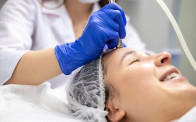 Microneedling Treatment in San Gabriel, CA