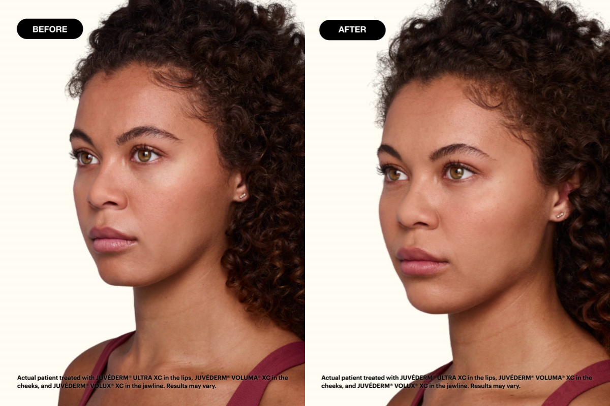 Juvederm Filler Before and After Jazz Juvederm Filler Before and After Jazz from left to right