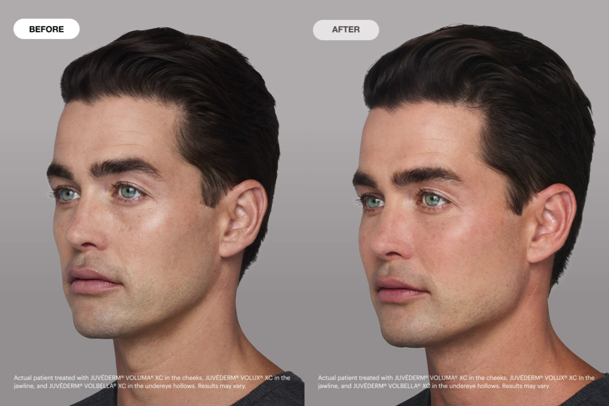 Juvederm Before and After Sterling Juvederm Before and After Sterling