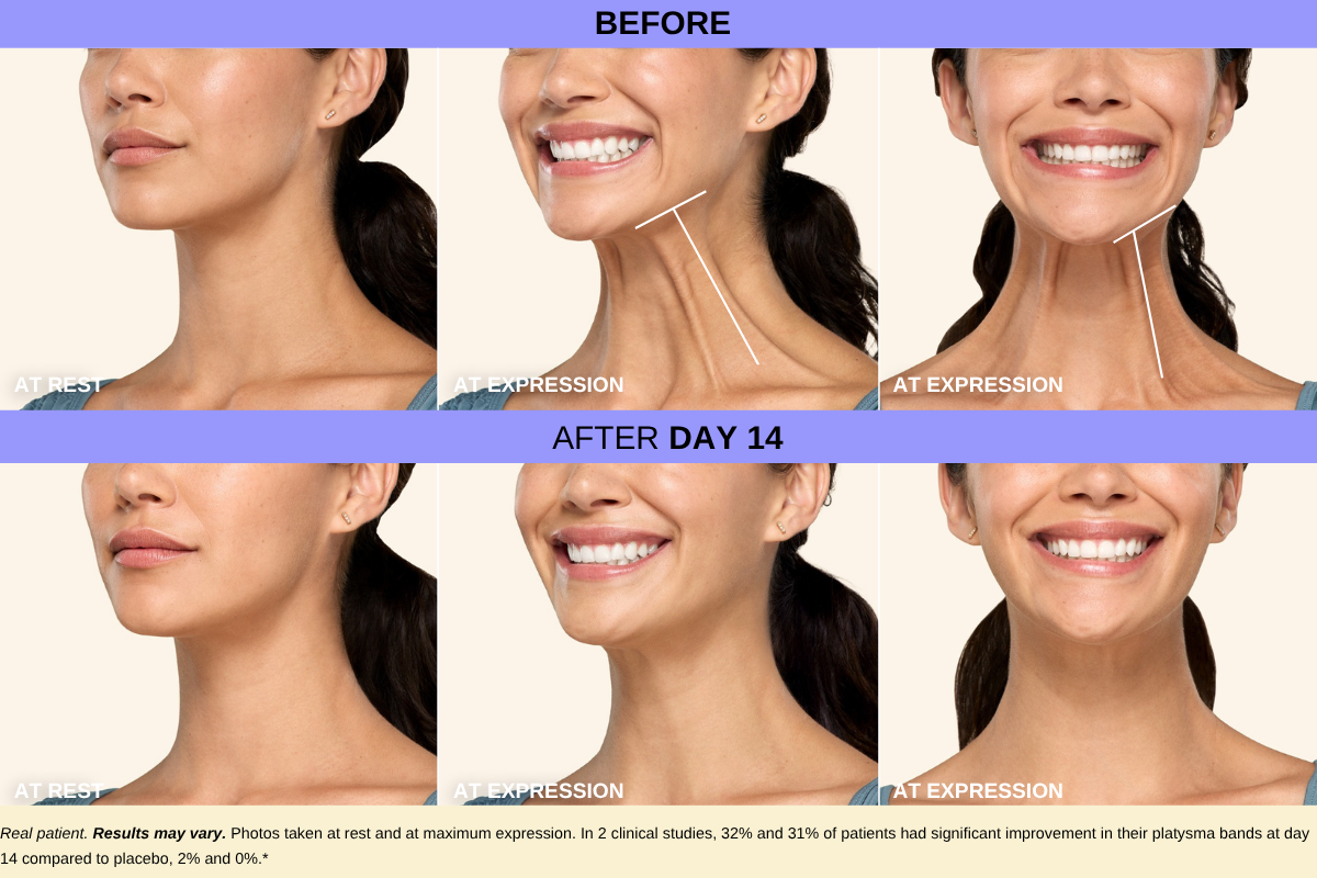 botox neck vanessa before and after Botox for the neck on real patient Vanessa before and after triple image collage with before images on the top row and after images on the bottom, from left to right: at rest 45 degrees to the left, at expression 45 degrees to to the left, and front-facing