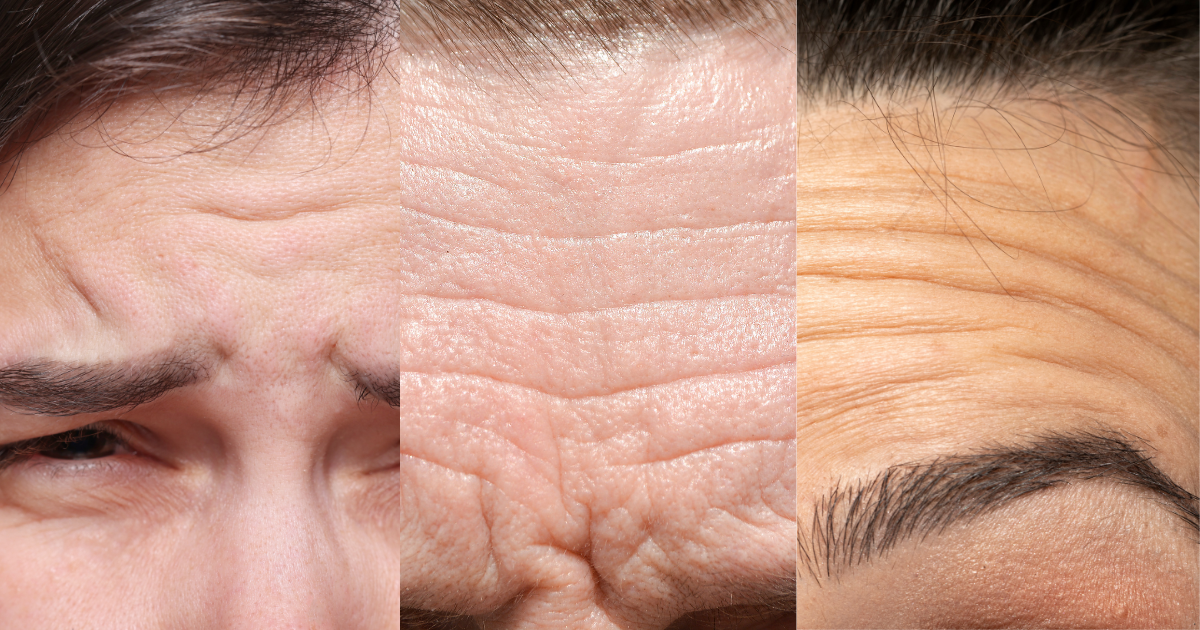 forehead lines botox graphic from left to right showing three examples of different types of forehead wrinkles