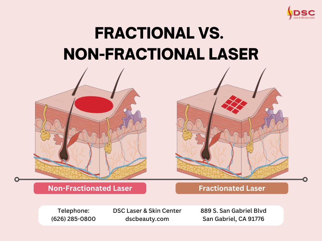 fractional vs non-fractional laser graphic