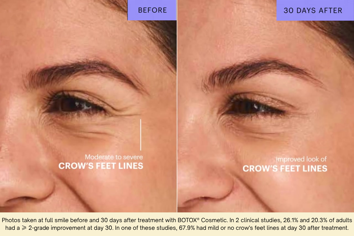 nicole botox crow's feet 30 day before and after collage of Botox treatment to the crow's feet on left side of face on Nicole from left to right