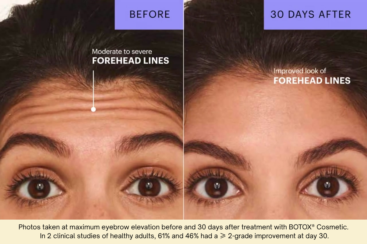 nicole botox forehead before and after 30 day before and after collage of Botox treatment to the forehead lines on Nicole from left to right