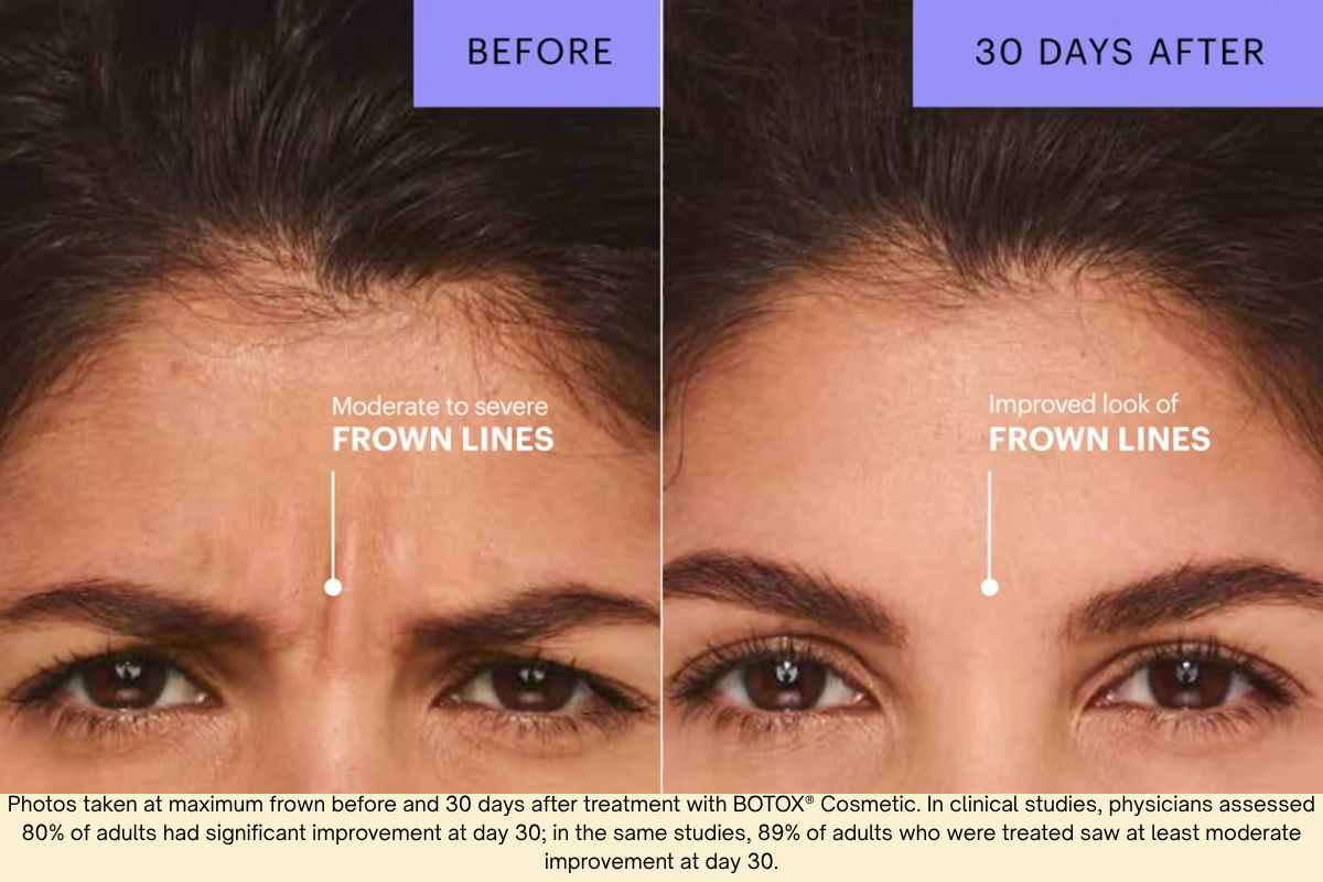 nicole botox frown lines before and after 30 day before and after collage of Botox treatment to the frown lines between eyebrows on Nicole from left to right