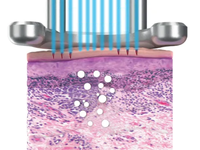Pico Laser LIOB graphic Pico laser light induced optical breakdown graphic showing plasma vacuole creation due to pico laser treatment for resurfacing, wrinkles, texture