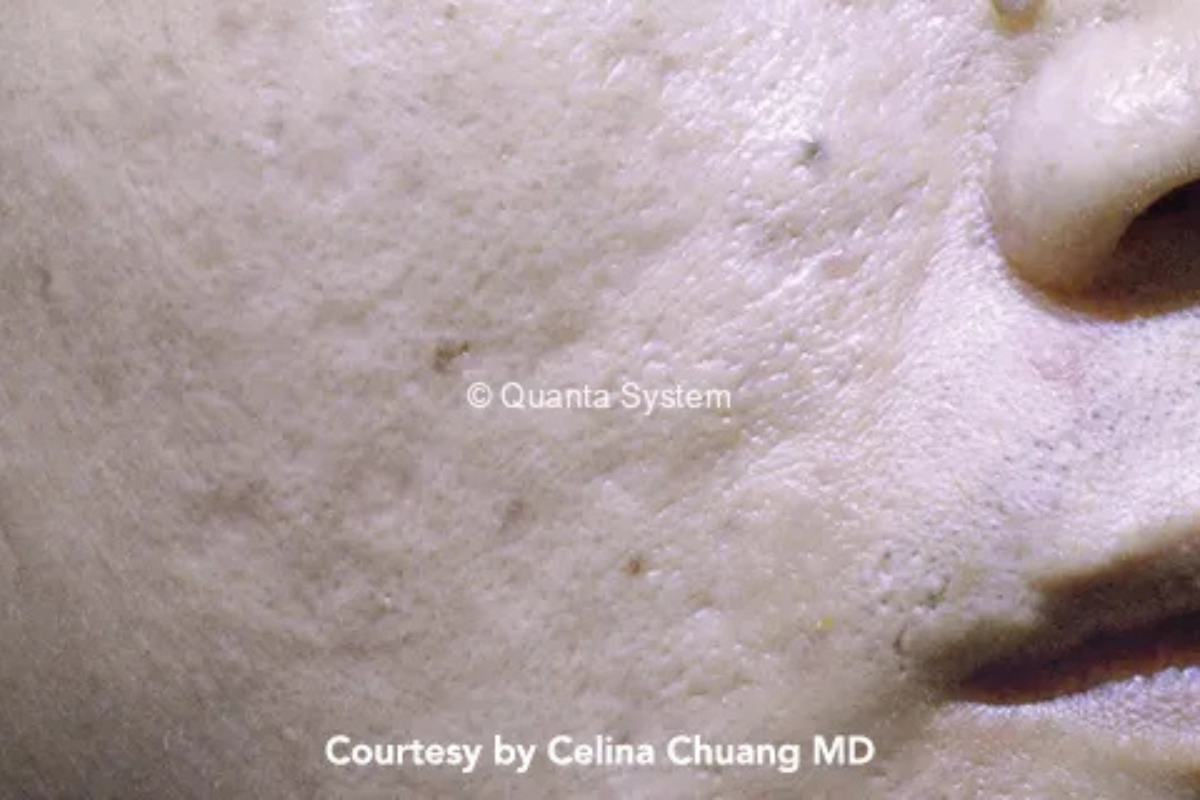 pico laser acne scar after
