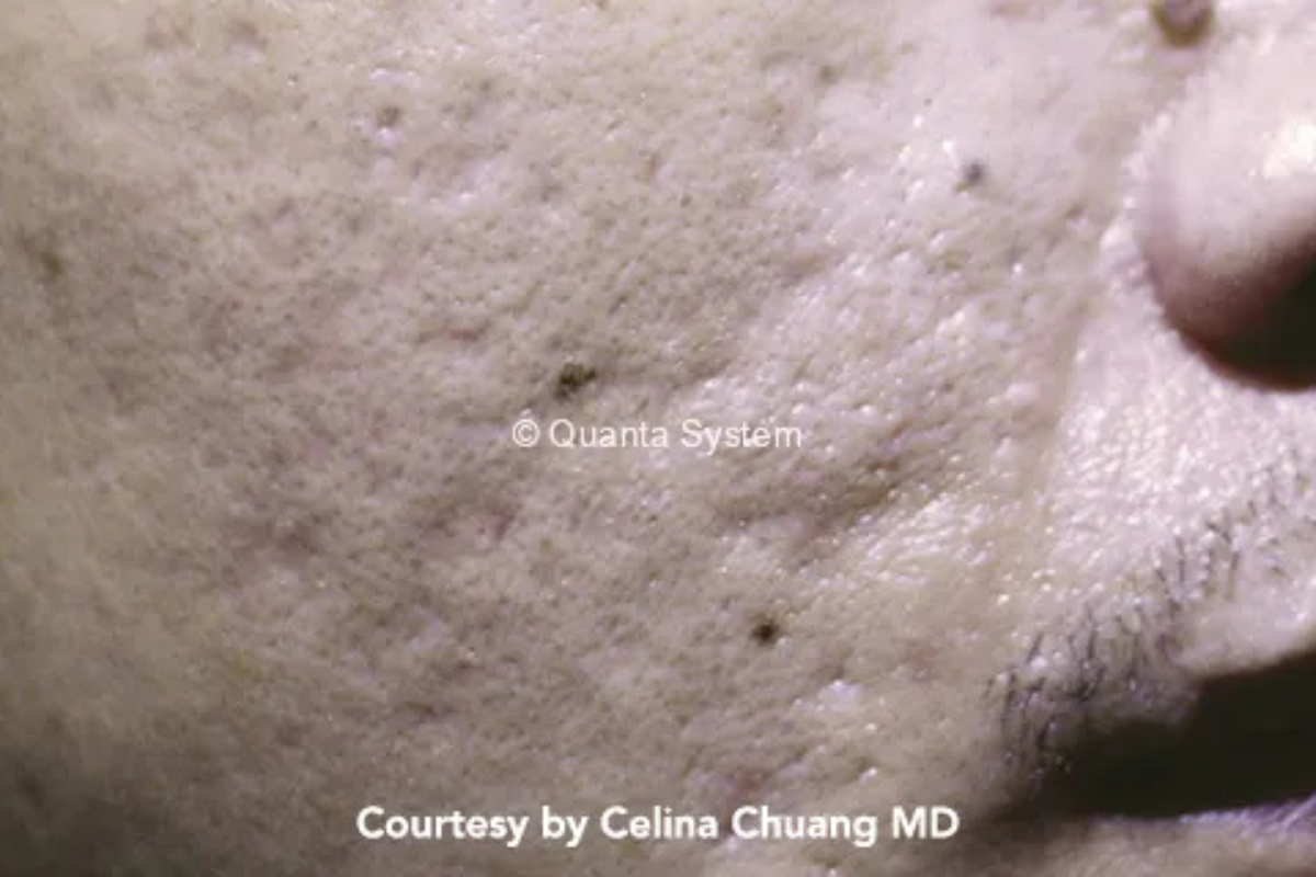 pico laser acne scar before