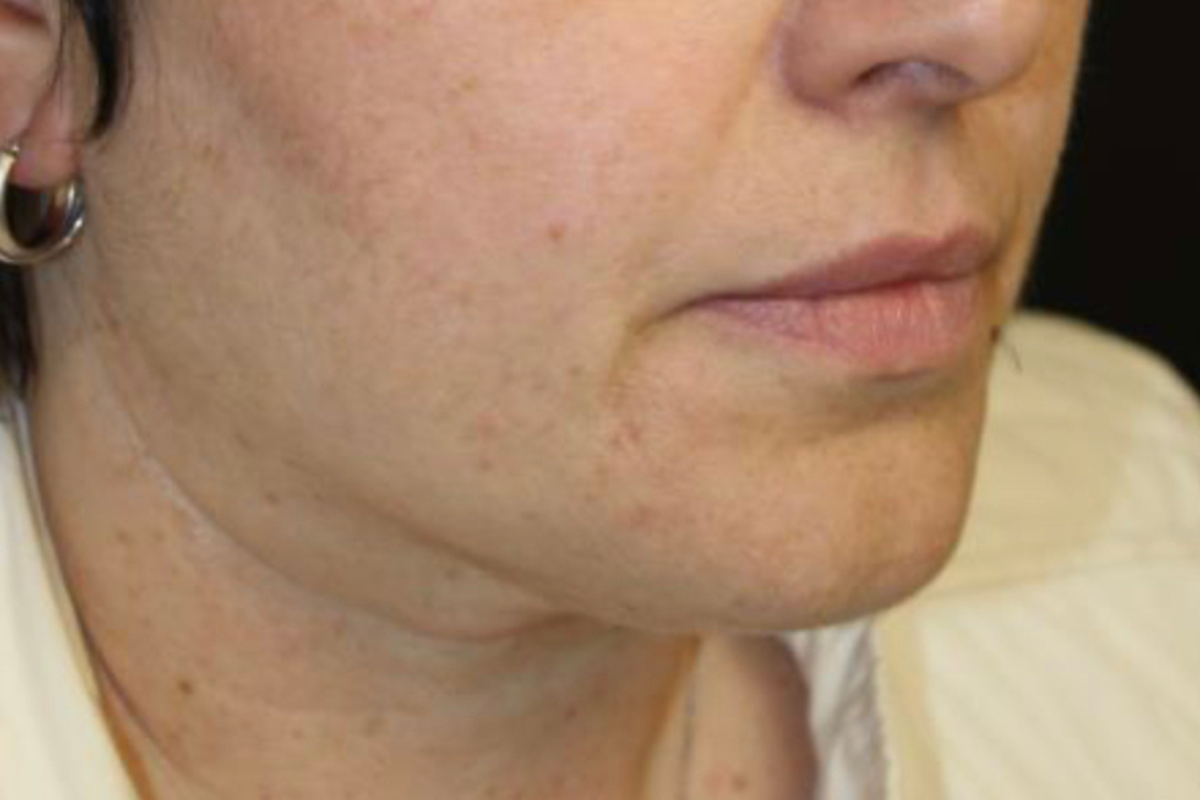 pico laser pigment after cheek