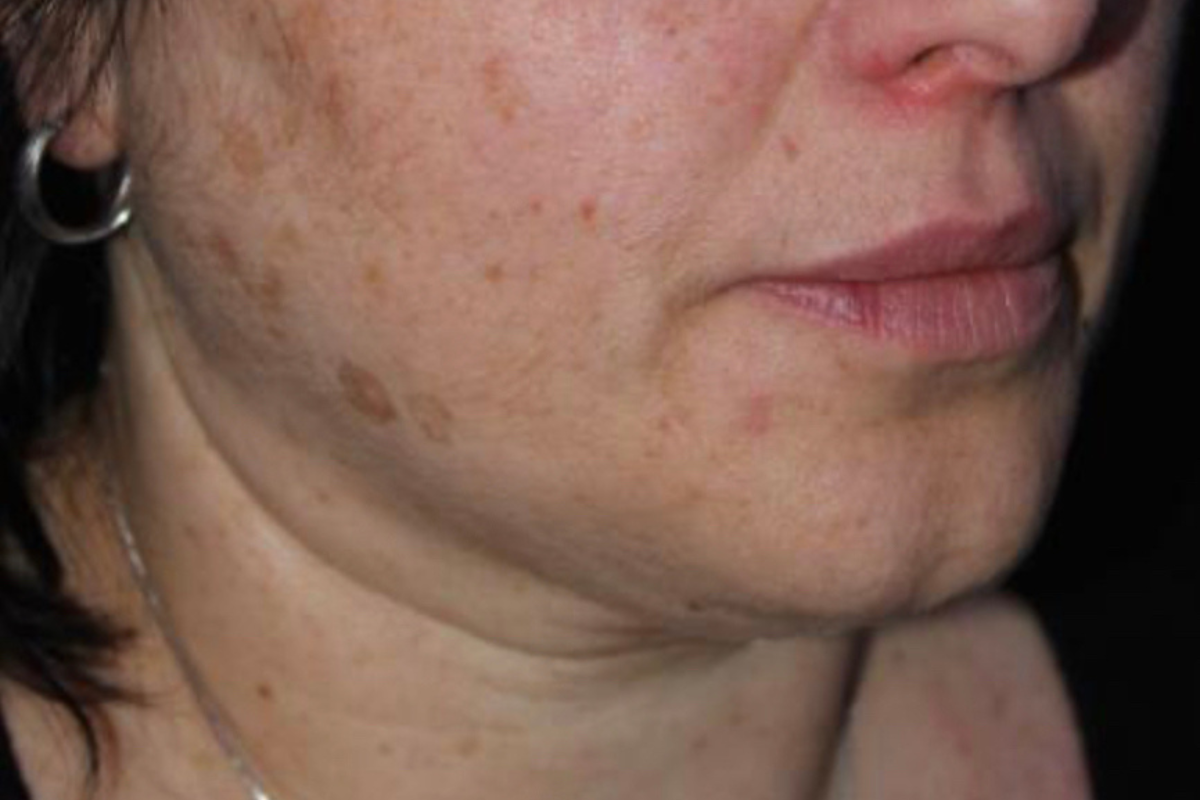 pico laser pigment before cheek