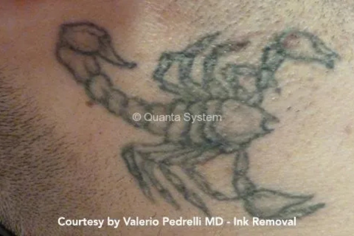 pico laser tattoo before scorpion