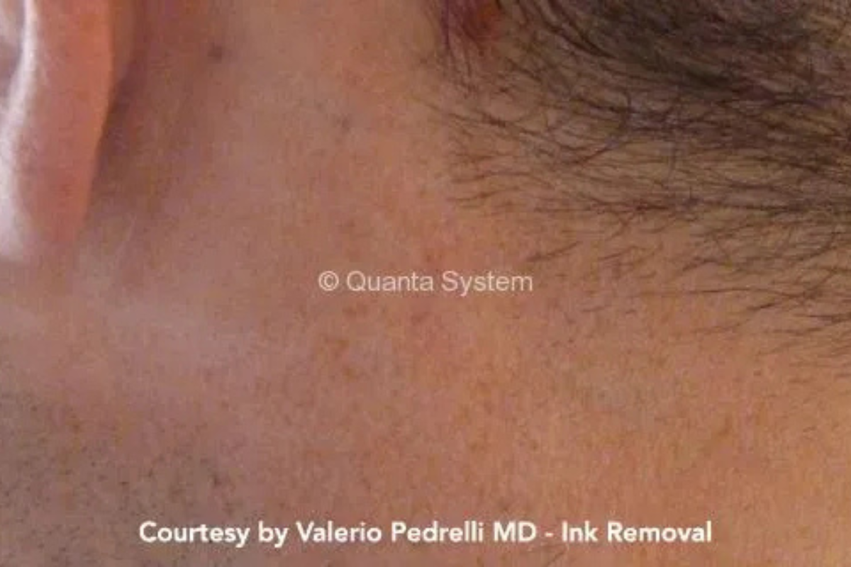 pico laser tattoo removal after behind ear