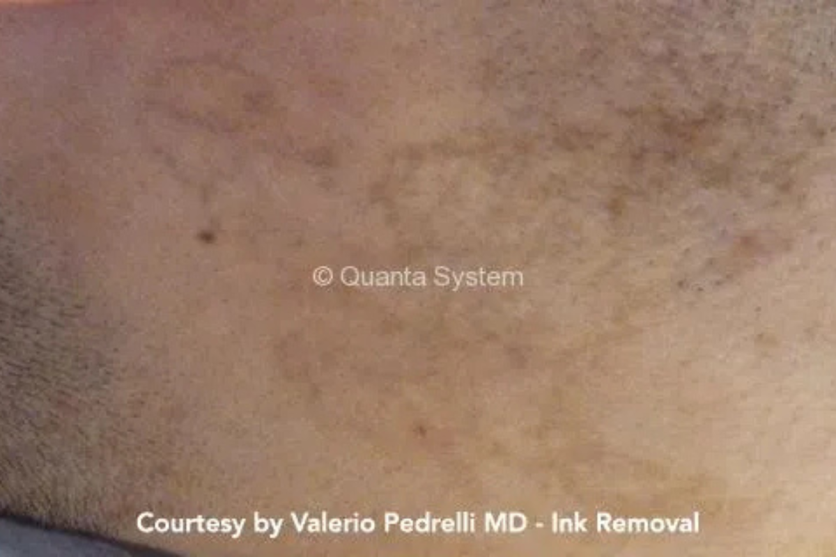 pico laser tattoo removal after scorpion