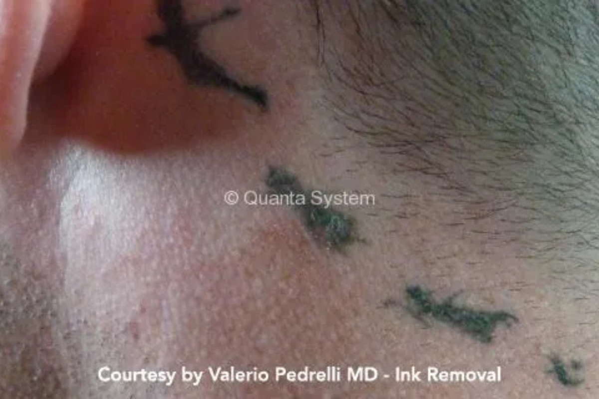 pico laser tattoo removal before behind ear