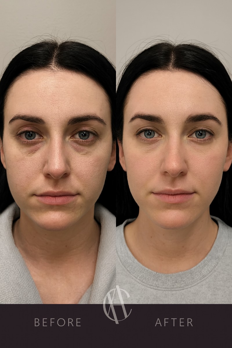 recovery-and-aftercare-tips-eye-filler-san-gabriel