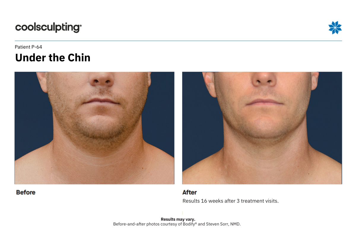 coolsculpting before and after P-64 under the chin front coolsculpting before and after P-64 under the chin front