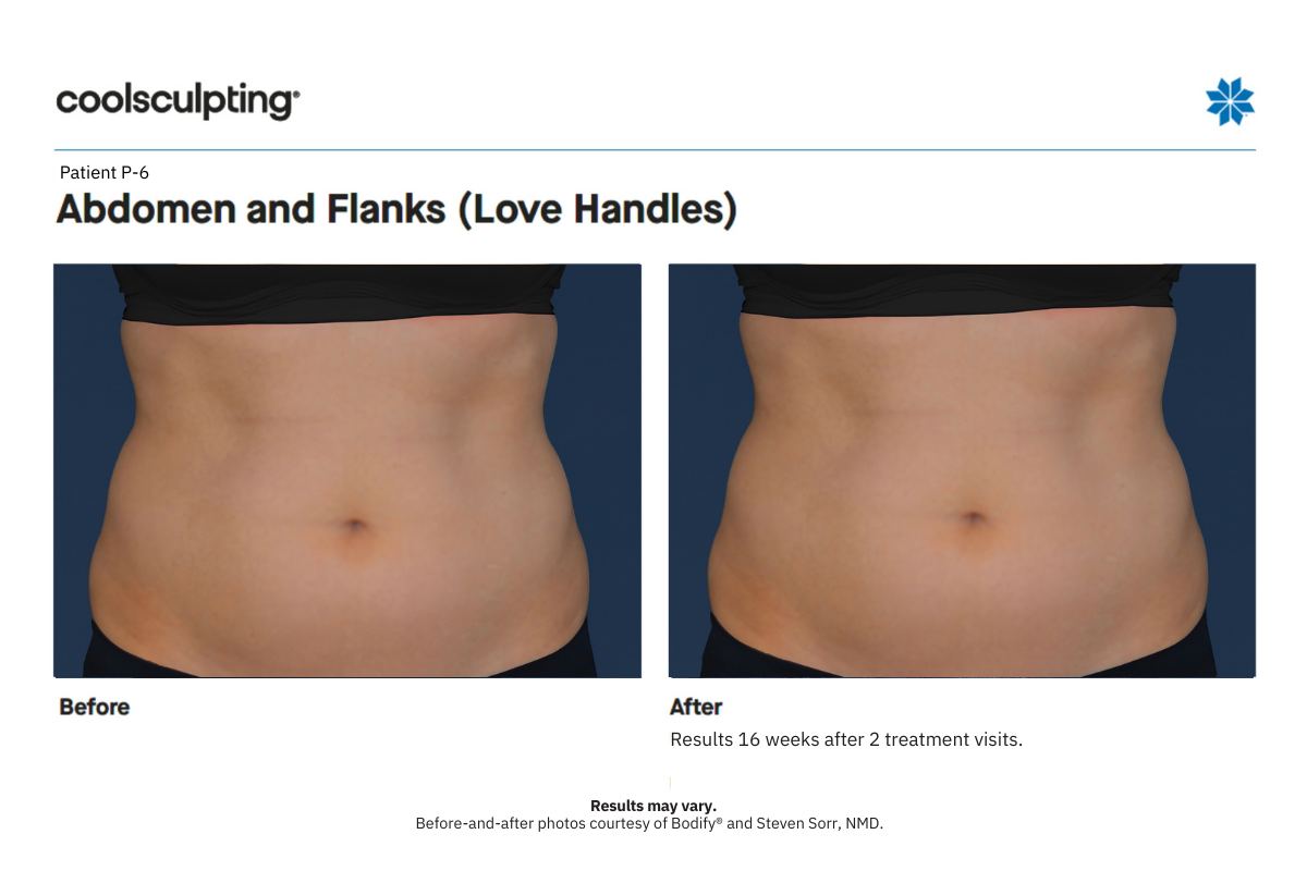coolsculpting before and after P6 abdomen front coolsculpting before and after P6 abdomen front